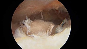 Rotator Cuff Tear - Rotator cuff reapir, after completion