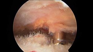 Rotator Cuff Tear - Rotator cuff tear as viewed from top side